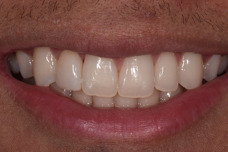 Patient Smile Before & After Gallery - Patient 242758 - Image 4
