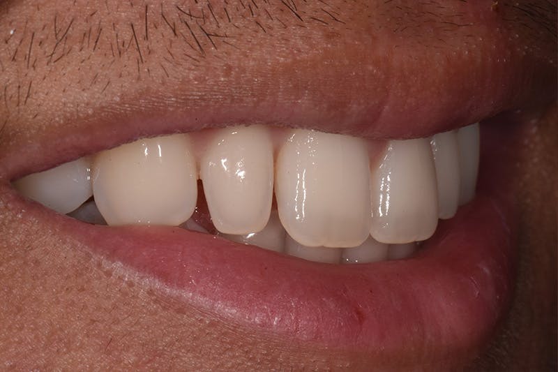 Patient Smile Before & After Gallery - Patient 242758 - Image 5