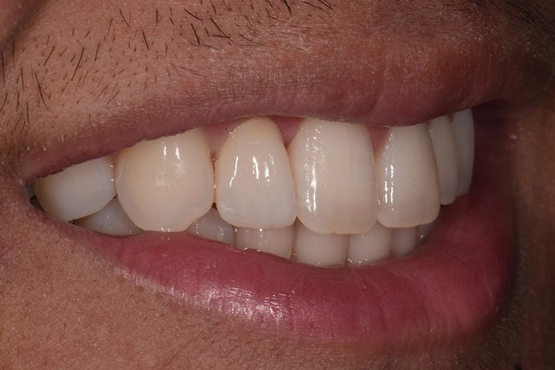 Patient Smile Before & After Gallery - Patient 242758 - Image 6