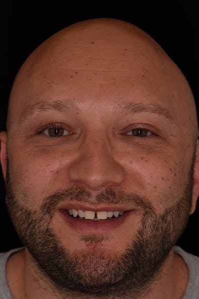 Patient Smile Before & After Gallery - Patient 242742 - Image 1