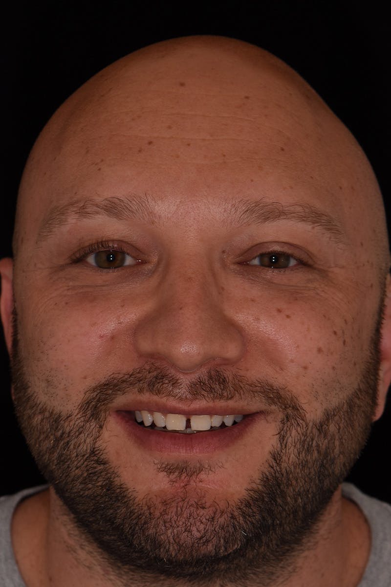 Patient Smile Before & After Gallery - Patient 242742 - Image 1