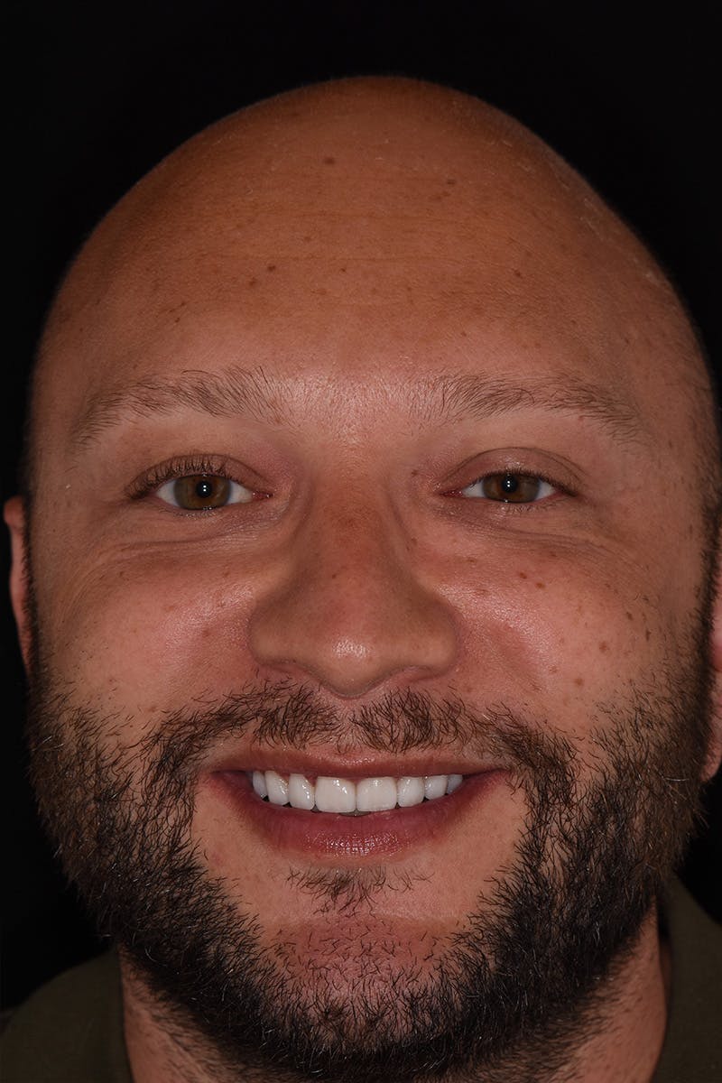 Patient Smile Before & After Gallery - Patient 242742 - Image 2