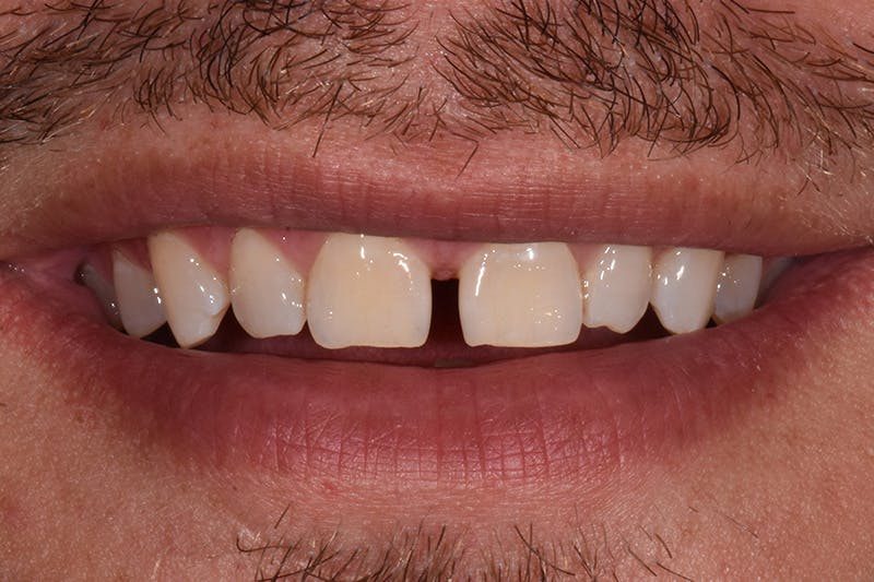 Patient Smile Before & After Gallery - Patient 242742 - Image 3