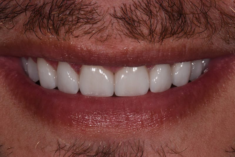 Patient Smile Before & After Gallery - Patient 242742 - Image 4