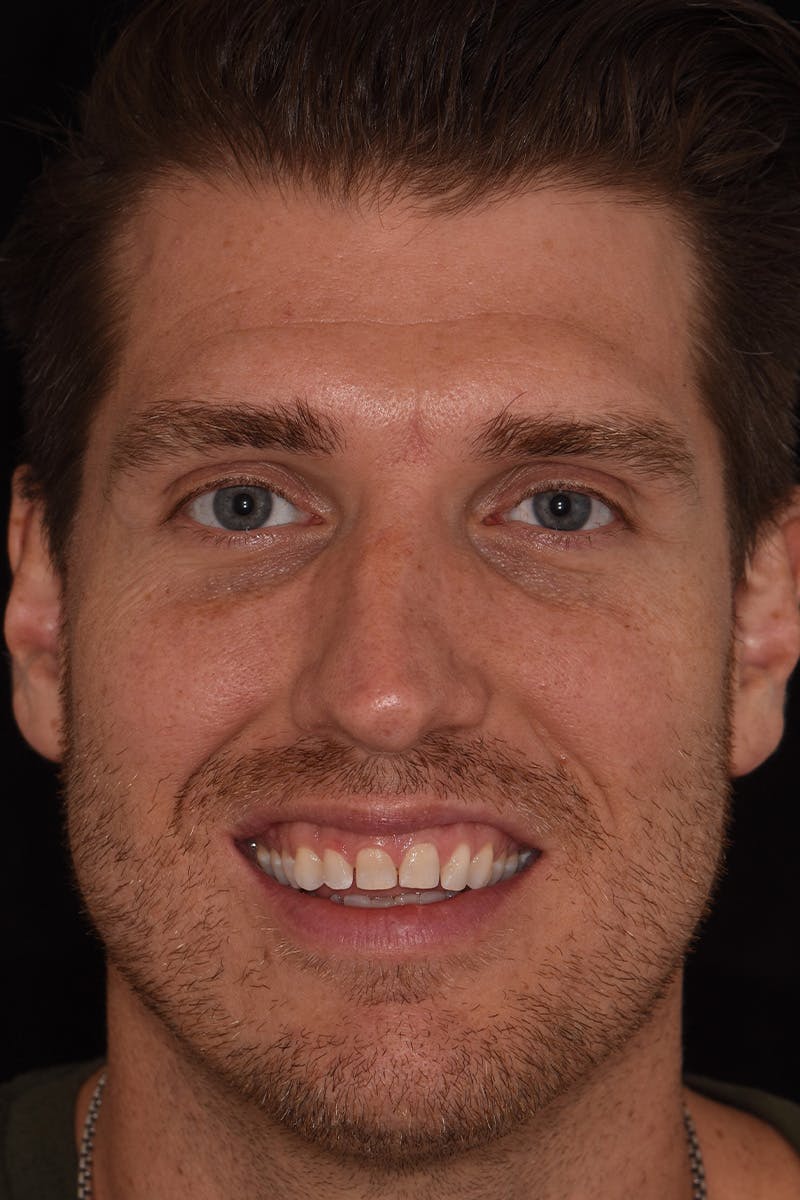 Patient Smile Before & After Gallery - Patient 367370 - Image 1