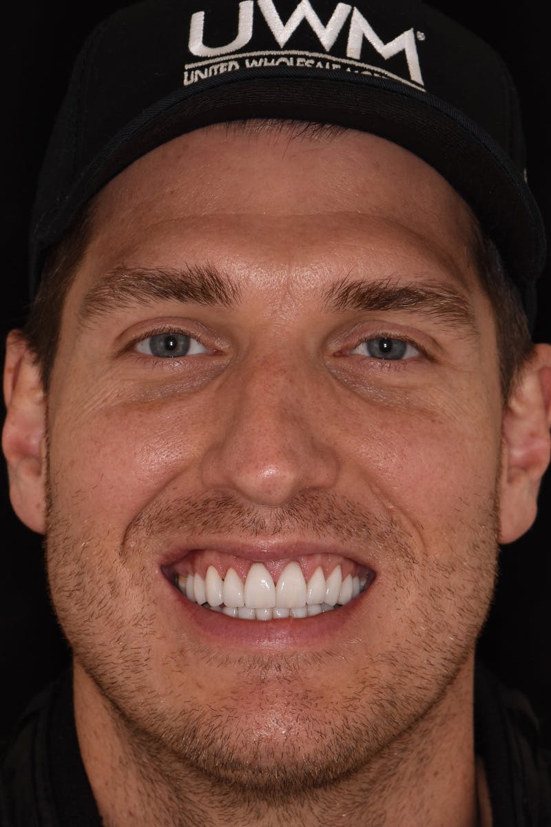 Patient Smile Before & After Gallery - Patient 367370 - Image 2