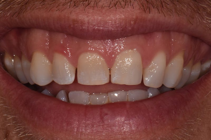 Patient Smile Before & After Gallery - Patient 367370 - Image 3