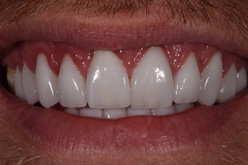 Patient Smile Before & After Gallery - Patient 367370 - Image 4