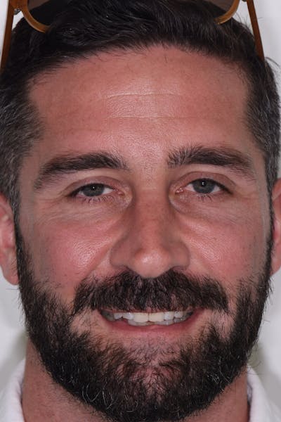 Patient Smile Before & After Gallery - Patient 268002 - Image 1