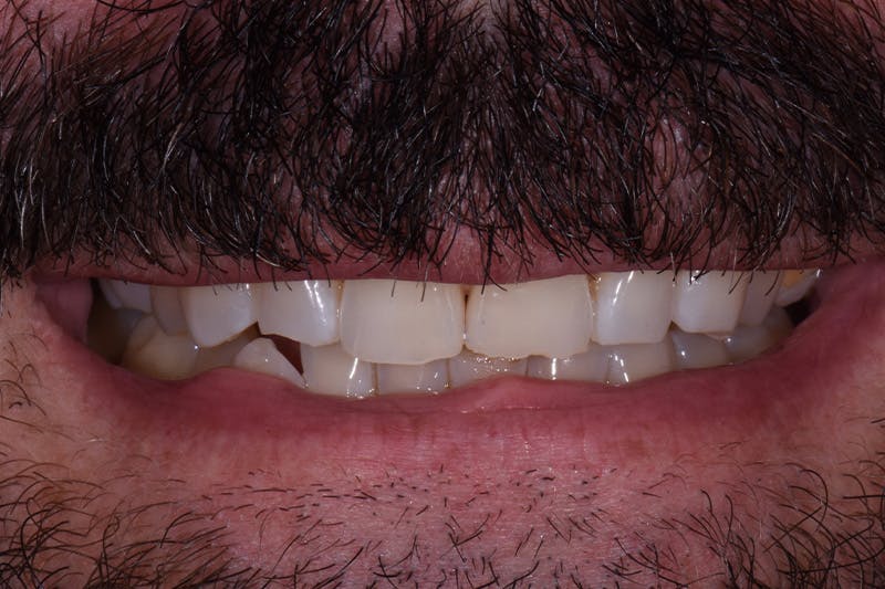 Patient Smile Before & After Gallery - Patient 268002 - Image 3