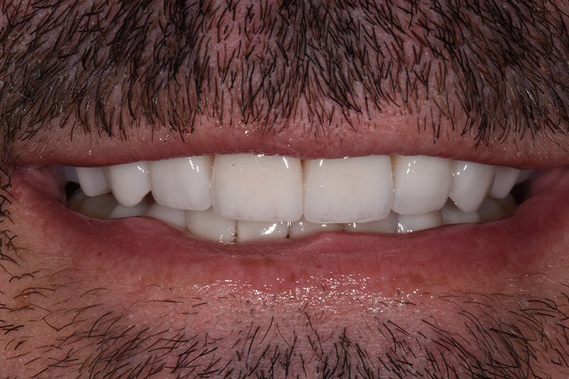 Patient Smile Before & After Gallery - Patient 268002 - Image 4
