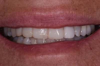 Patient Smile Before & After Gallery - Patient 272651 - Image 1