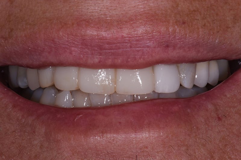 Patient Smile Before & After Gallery - Patient 272651 - Image 1