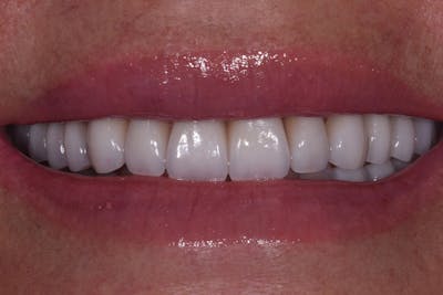 Patient Smile Before & After Gallery - Patient 272651 - Image 2