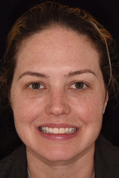 Patient Smile Before & After Gallery - Patient 281750 - Image 1