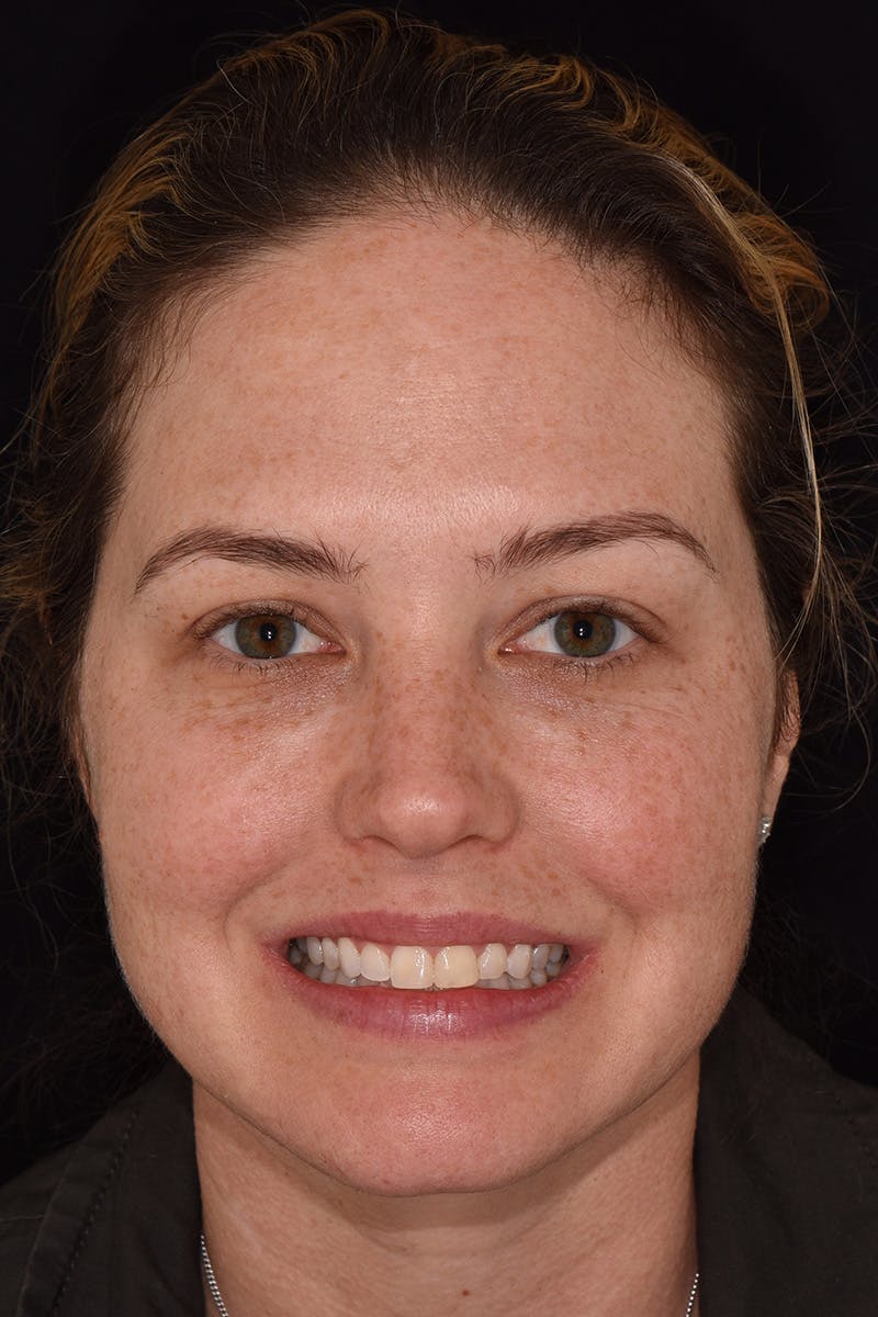 Patient Smile Before & After Gallery - Patient 281750 - Image 1