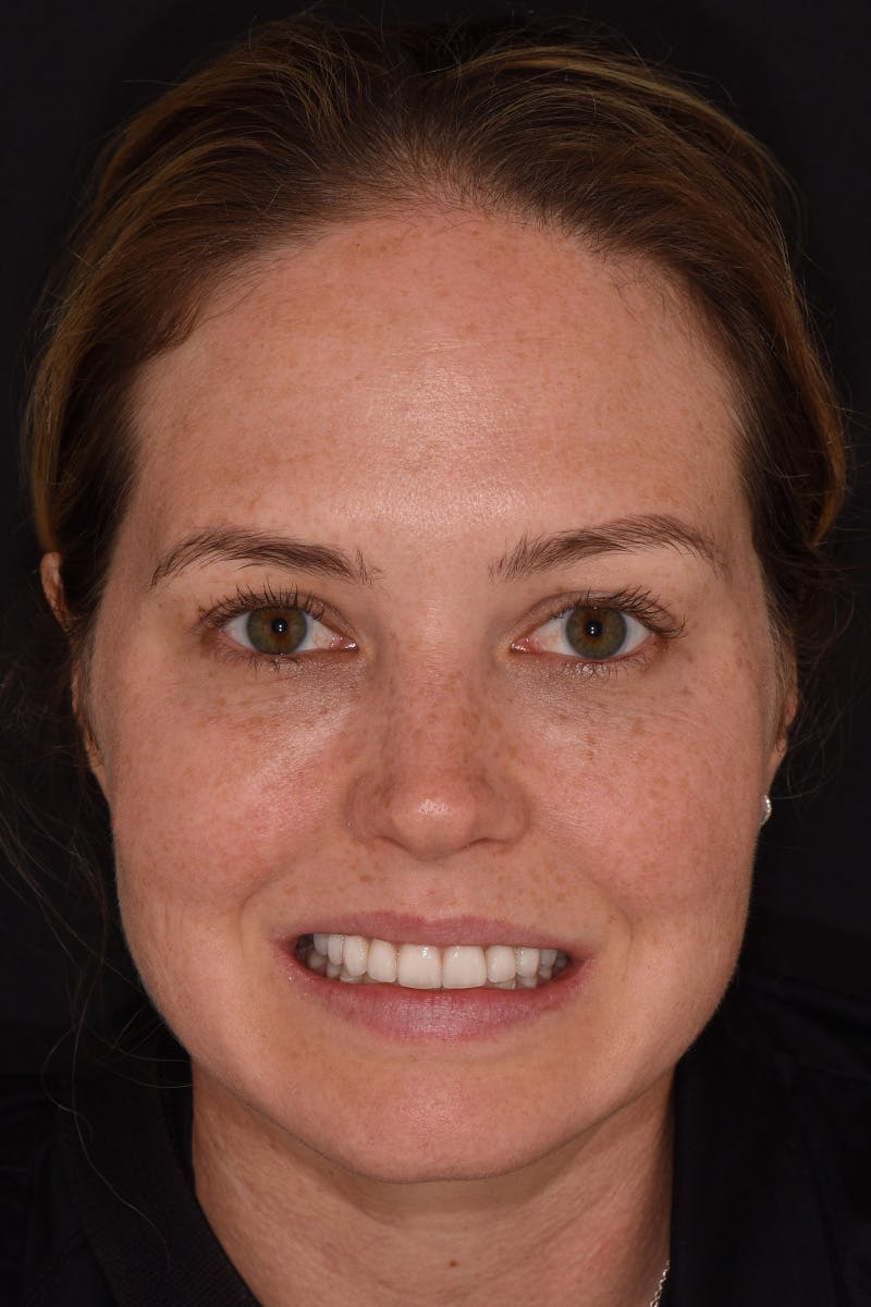 Patient Smile Before & After Gallery - Patient 281750 - Image 2