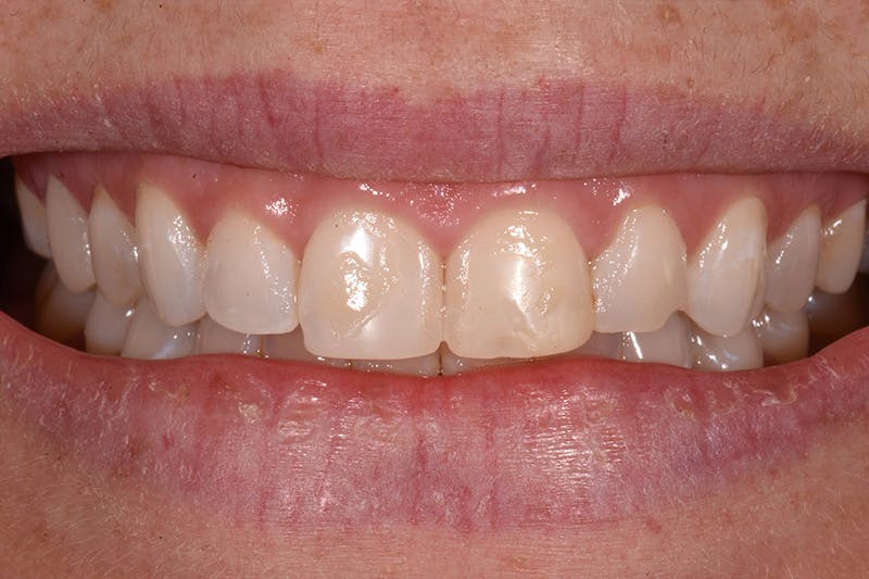Patient Smile Before & After Gallery - Patient 281750 - Image 3