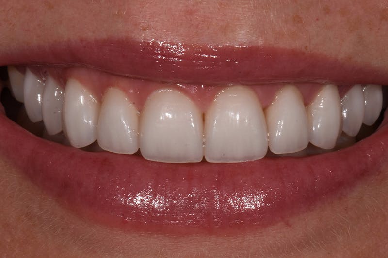 Patient Smile Before & After Gallery - Patient 281750 - Image 4
