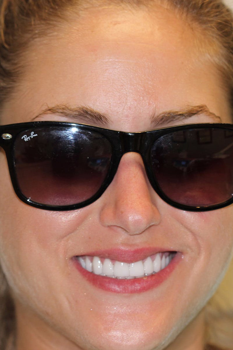 Patient Smile Before & After Gallery - Patient 205005 - Image 2