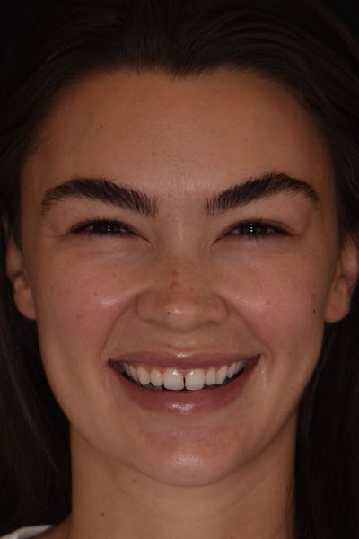 Patient Smile Before & After Gallery - Patient 599590 - Image 1