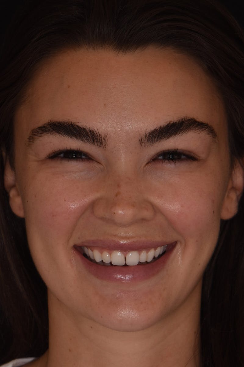 Patient Smile Before & After Gallery - Patient 599590 - Image 1