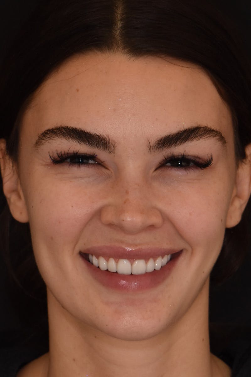 Patient Smile Before & After Gallery - Patient 599590 - Image 2