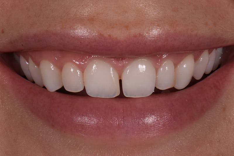 Patient Smile Before & After Gallery - Patient 599590 - Image 3
