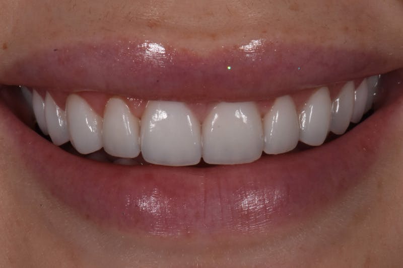 Patient Smile Before & After Gallery - Patient 599590 - Image 4