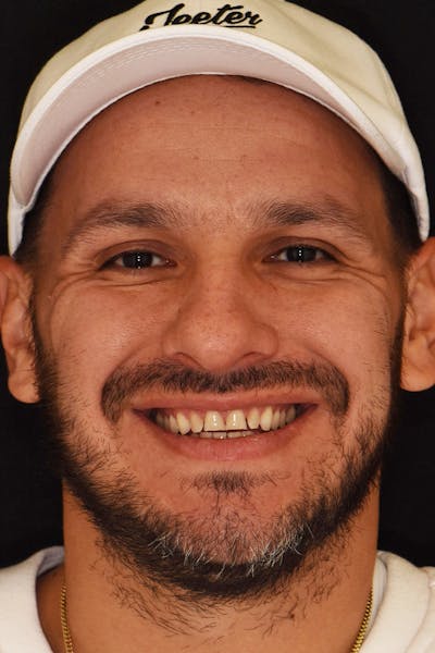 Patient Smile Before & After Gallery - Patient 370940 - Image 1