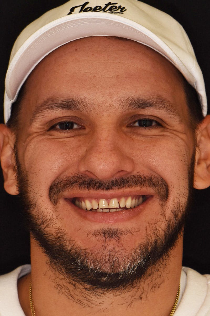 Patient Smile Before & After Gallery - Patient 370940 - Image 1