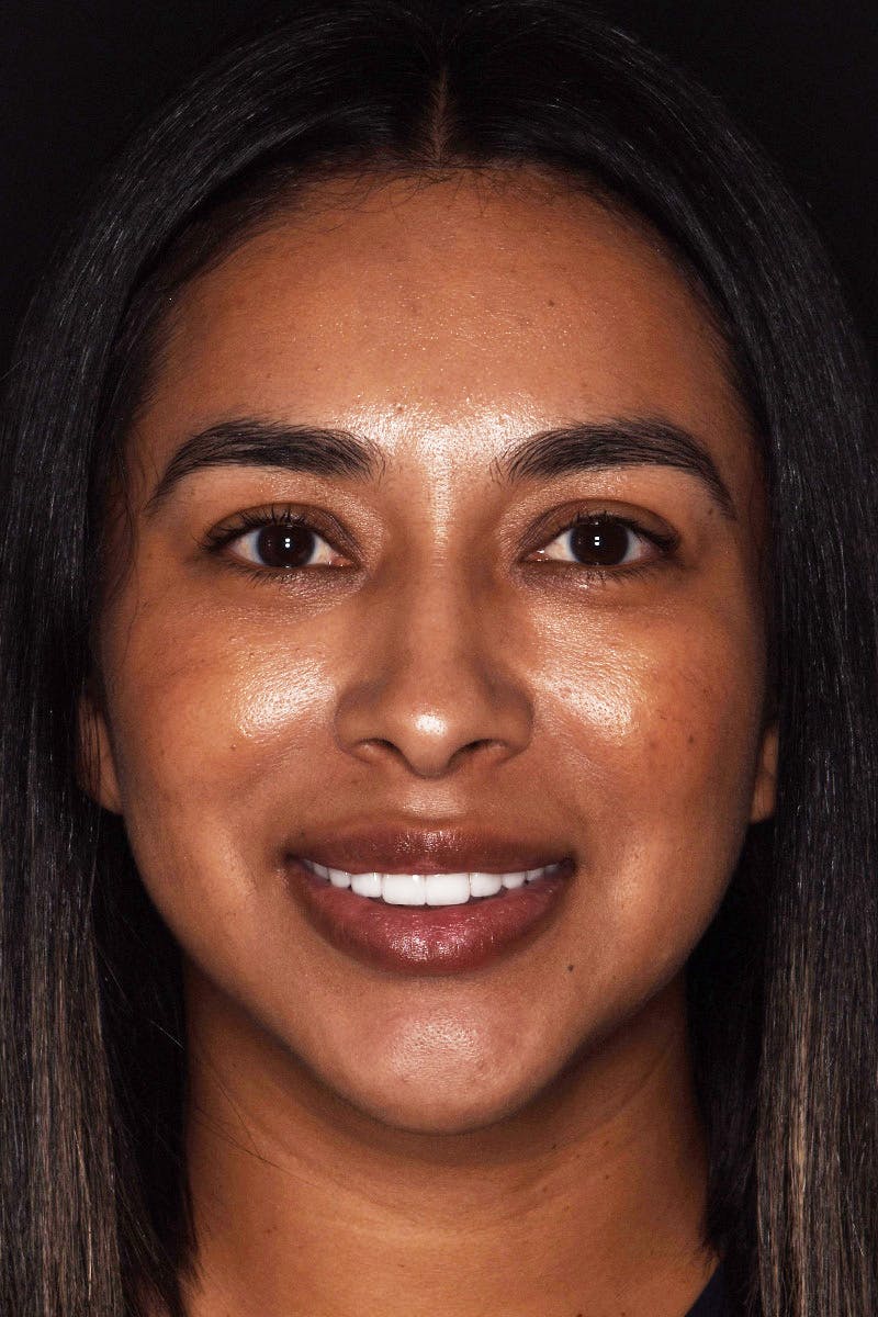 Patient Smile Before & After Gallery - Patient 144897 - Image 2
