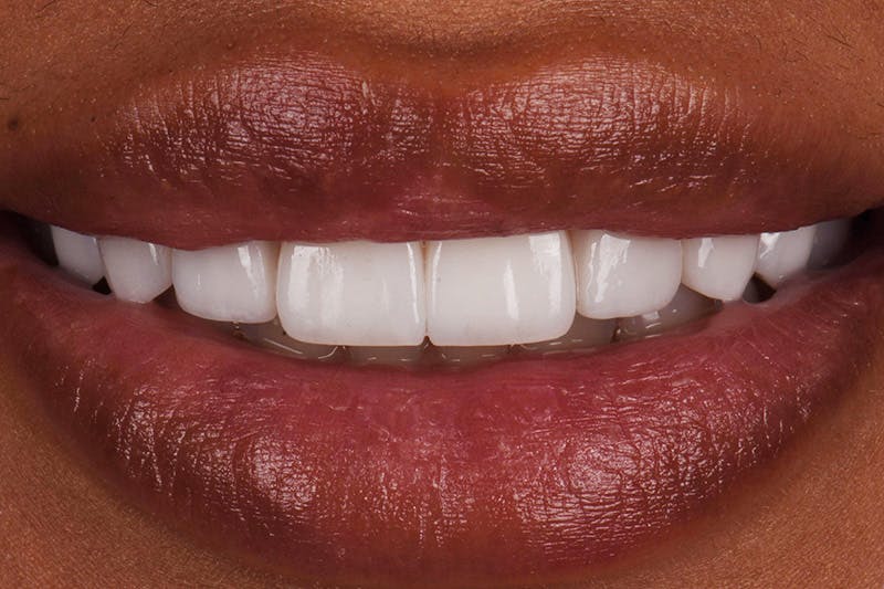 Patient Smile Before & After Gallery - Patient 144897 - Image 4