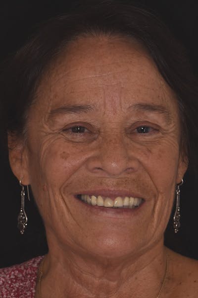 Patient Smile Before & After Gallery - Patient 128921 - Image 1