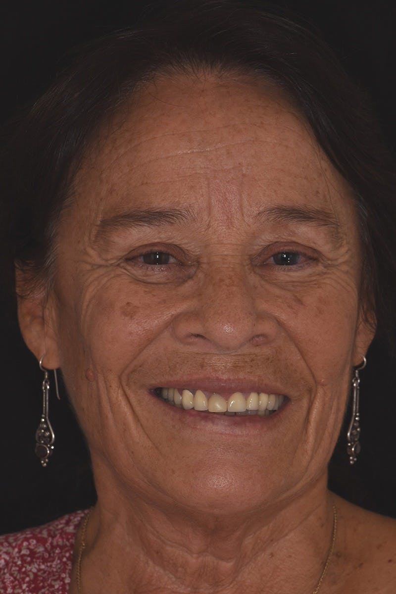 Patient Smile Before & After Gallery - Patient 128921 - Image 1