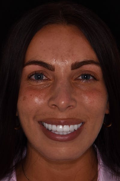 Patient Smile Before & After Gallery - Patient 218624 - Image 2