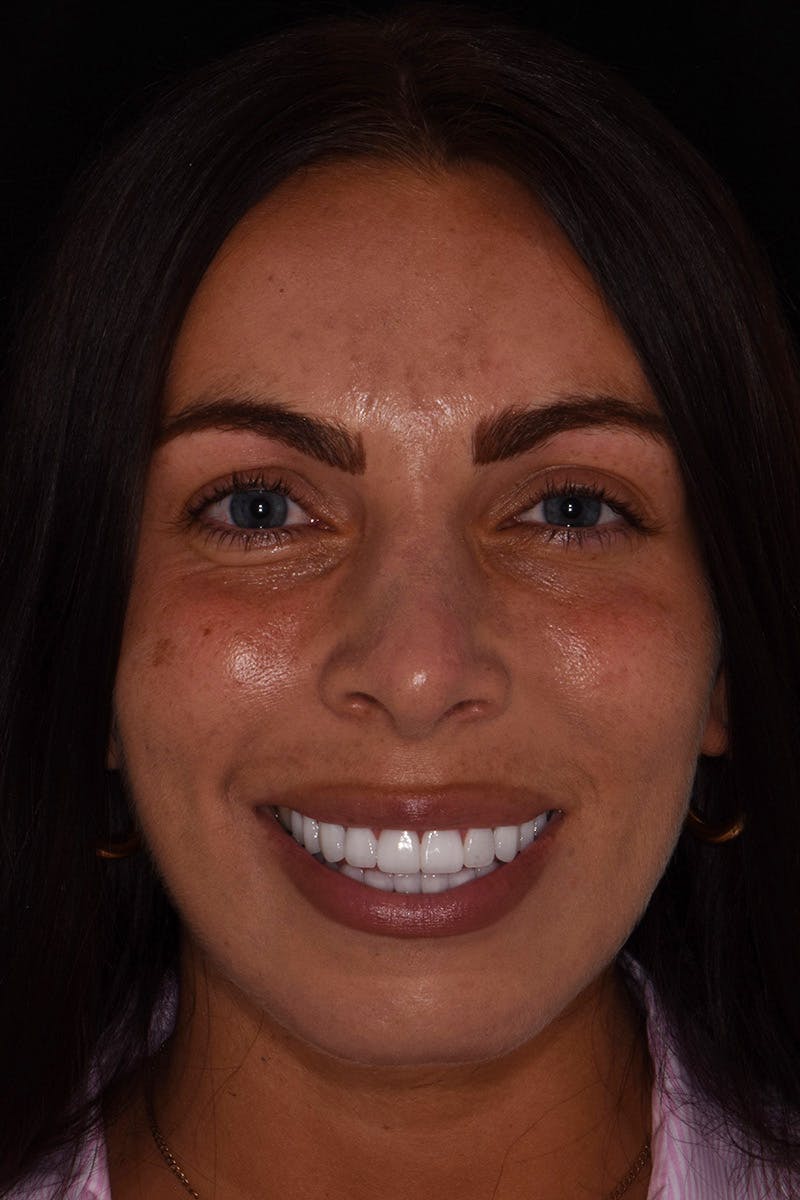 Patient Smile Before & After Gallery - Patient 218624 - Image 2