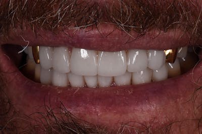 Patient Smile Before & After Gallery - Patient 627381 - Image 2