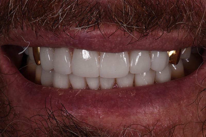 Patient Smile Before & After Gallery - Patient 627381 - Image 2