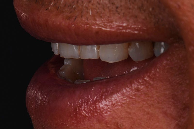 Patient Smile Before & After Gallery - Patient 148640 - Image 5