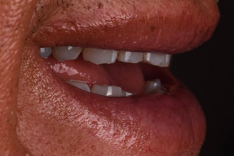 Patient Smile Before & After Gallery - Patient 148640 - Image 7