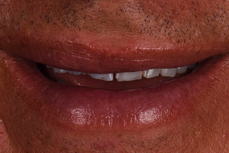 Patient Smile Before & After Gallery - Patient 148640 - Image 9