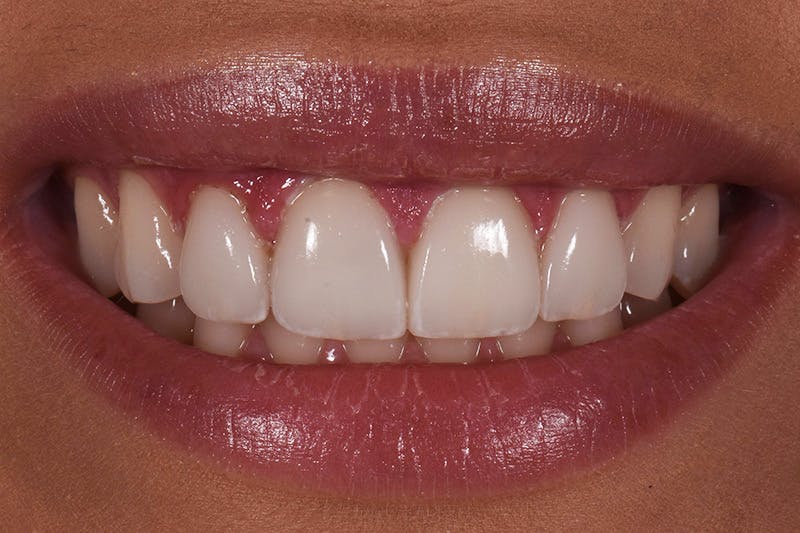 Patient Smile Before & After Gallery - Patient 267417 - Image 4