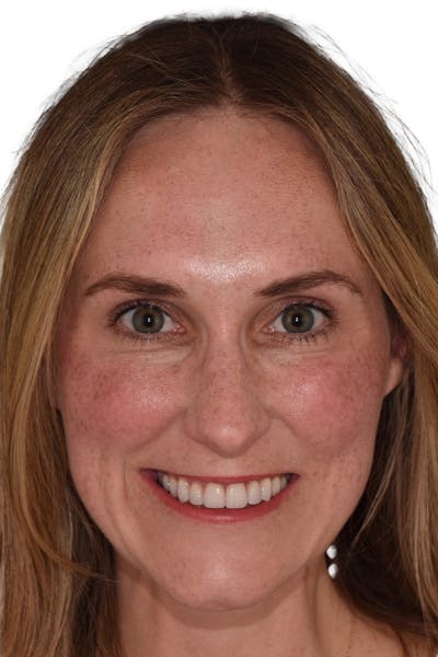 Patient Smile Before & After Gallery - Patient 170938 - Image 2