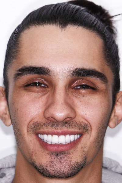 Patient Smile Before & After Gallery - Patient 378832 - Image 2