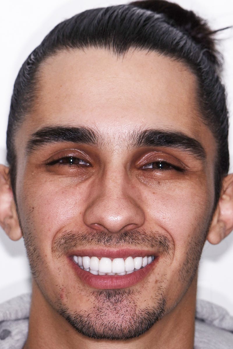 Patient Smile Before & After Gallery - Patient 378832 - Image 2