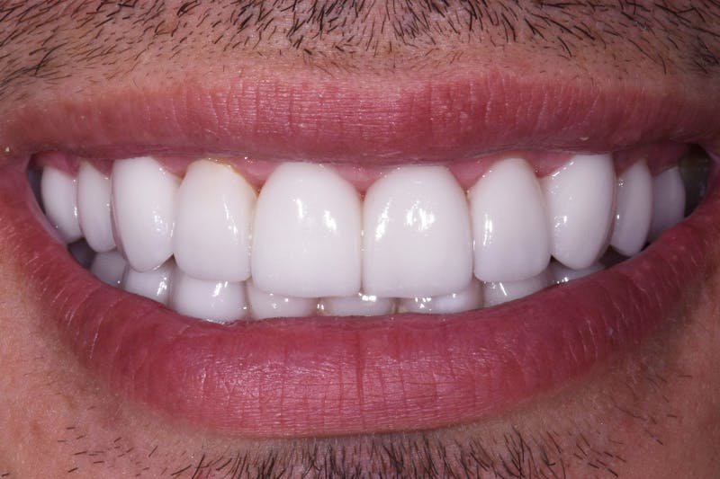 Patient Smile Before & After Gallery - Patient 378832 - Image 4