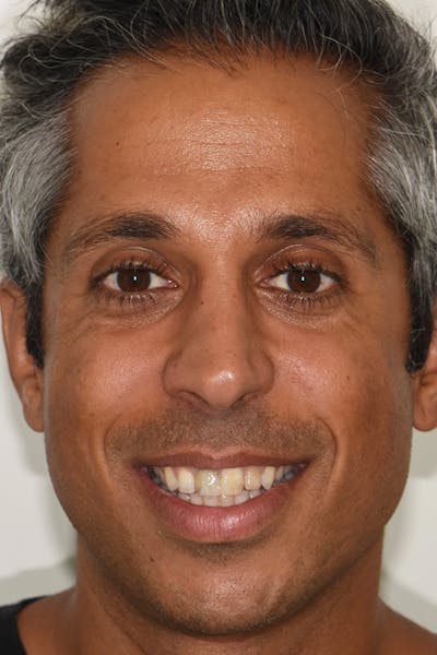 Patient Smile Before & After Gallery - Patient 368624 - Image 1