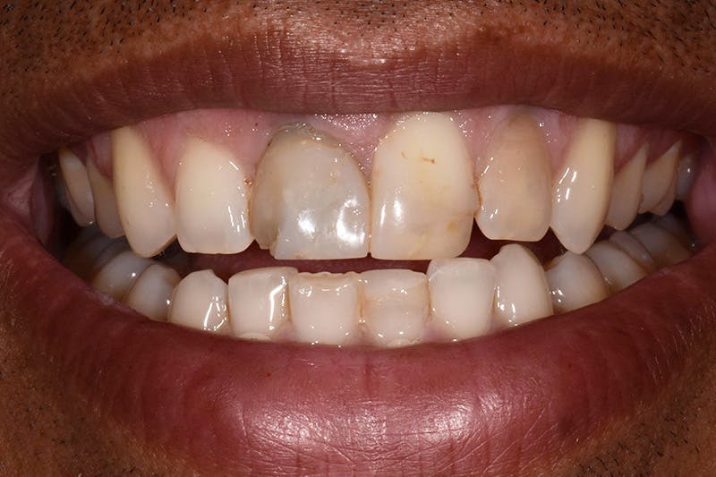 Patient Smile Before & After Gallery - Patient 368624 - Image 3