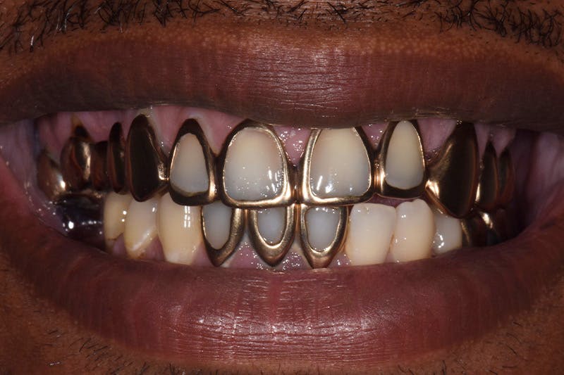 Patient Smile Before & After Gallery - Patient 224320 - Image 3